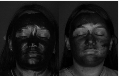 UV images after sunscreen or spf moisturiser